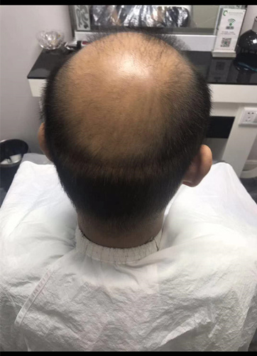 西寧織發(fā)補發(fā)哪家好，真的能改變我的脫發(fā)形象嗎？ 