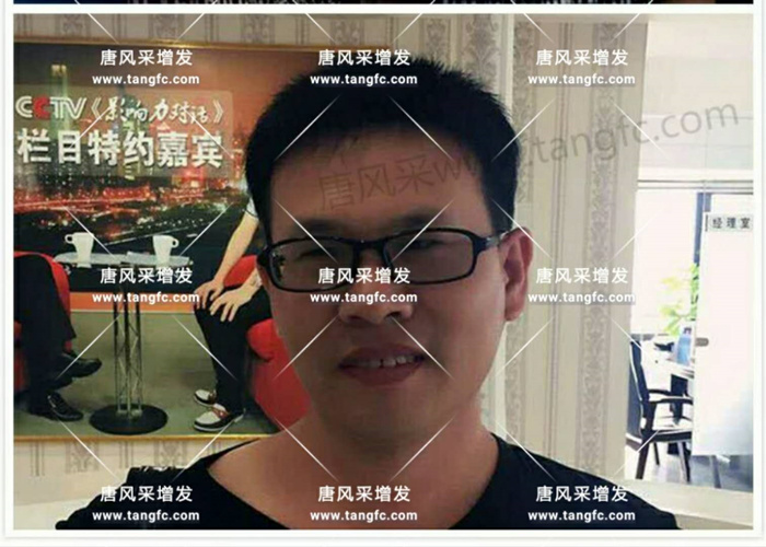 老師，我要你“脫”掉禿頂！