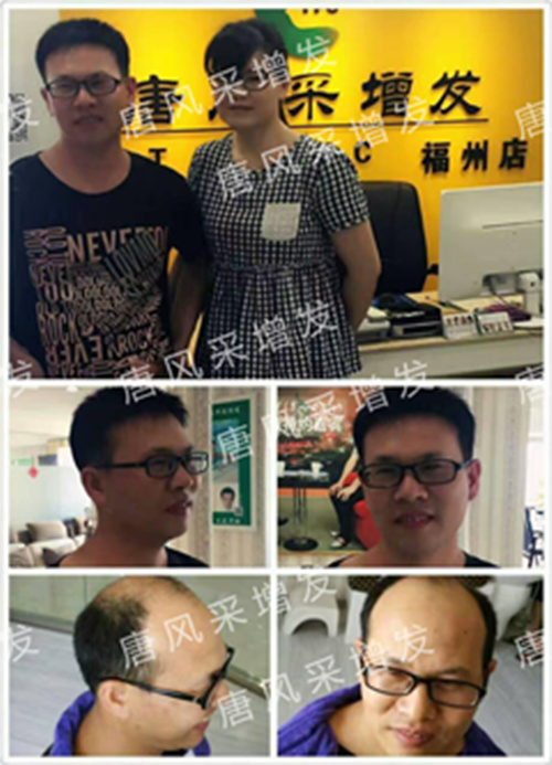 老師，我要你“脫”掉禿頂！