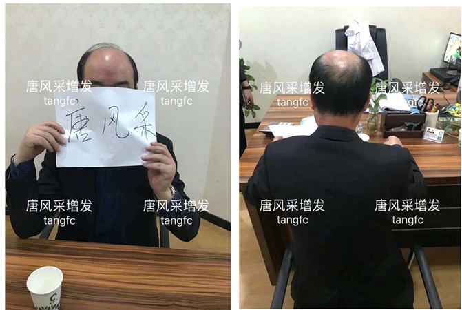 唐風(fēng)采增發(fā)案例 ，脫發(fā)謝頂后