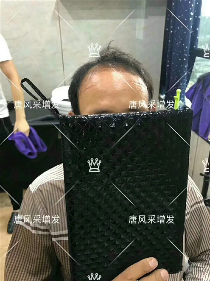 男人有這兩方面變化 雄性激素脫發(fā)
