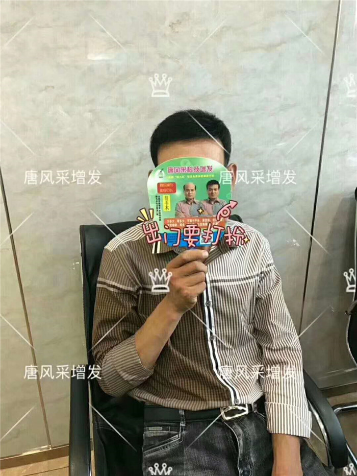 男人有這兩方面變化 雄性激素脫發(fā)是不可逆
