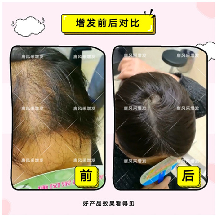 大連補(bǔ)發(fā)多少錢(qián)？原來(lái)頭發(fā)也可以這樣補(bǔ)