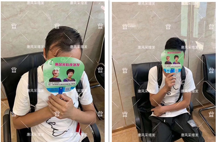 謝頂中年男 唐風采增發(fā)后對比圖客戶