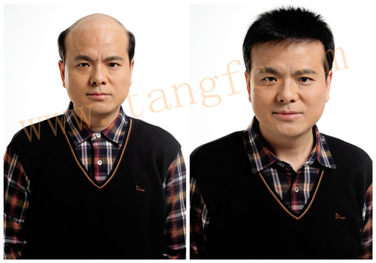 創(chuàng)始人唐利民 無痕增發(fā) 唐利民先生增發(fā)前后的效果