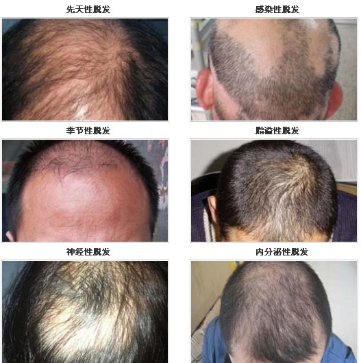唐風(fēng)采增發(fā)中秋雙節(jié)鉅惠 脫發(fā)