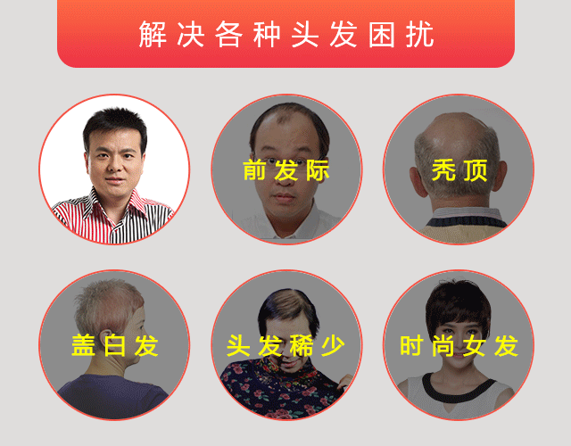 頭頂局部假發(fā) 唐風(fēng)采解決各種脫發(fā)原因