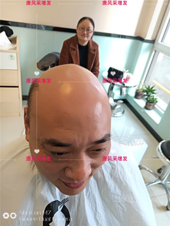 禿頂改造 唐風采客戶