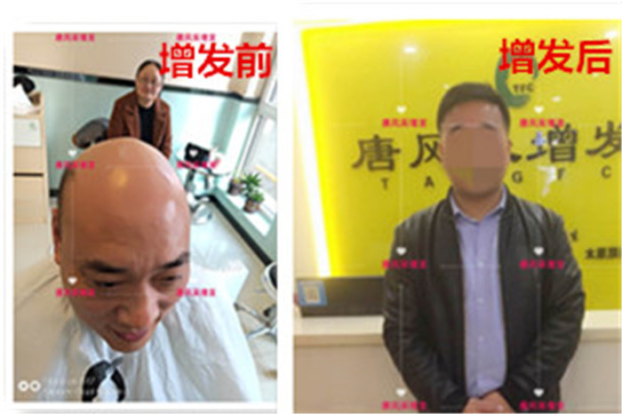 禿頂改造 唐風采客戶