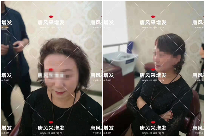 中老年頭發(fā)少 唐風(fēng)采客戶錢阿姨增發(fā)前后對比