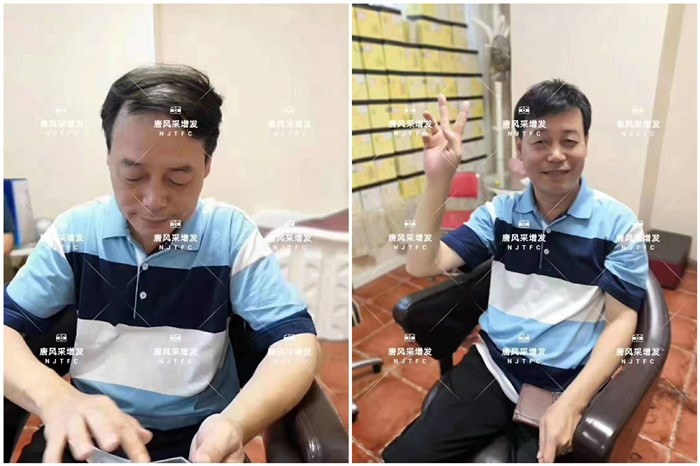 頭頂假發(fā)片 唐風(fēng)采客戶李先生增發(fā)前后