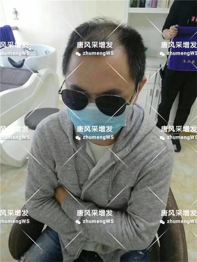 頭頂粘貼假發(fā)片哪里買 唐風(fēng)采客戶章先生增發(fā)前