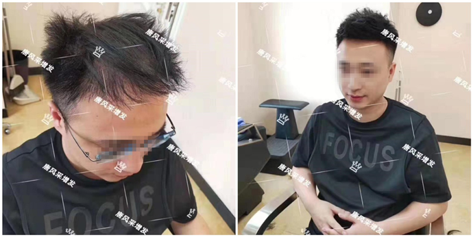 假發(fā)鬢角處怎么看著自然一點 量身定制假發(fā)跟其他假發(fā)對比