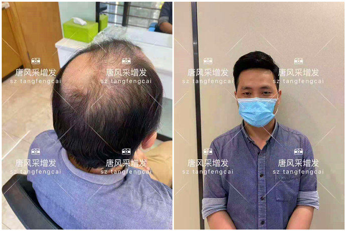 脫發(fā)人的中年危機 \