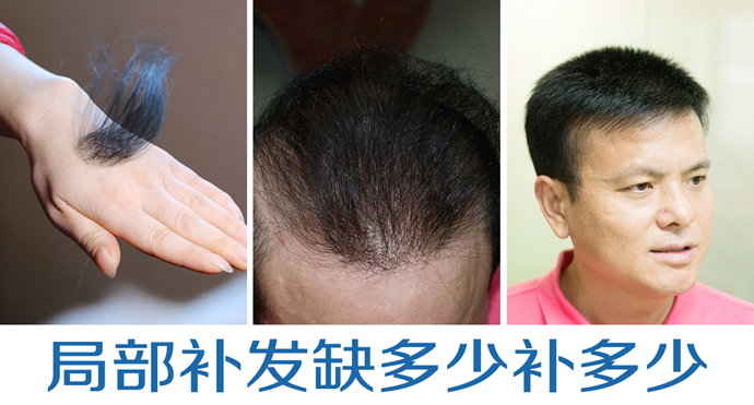 蓋頭頂粘貼假發(fā) \