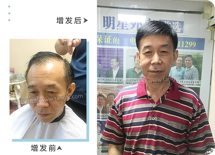 頭頂補(bǔ)發(fā)假發(fā)片 \