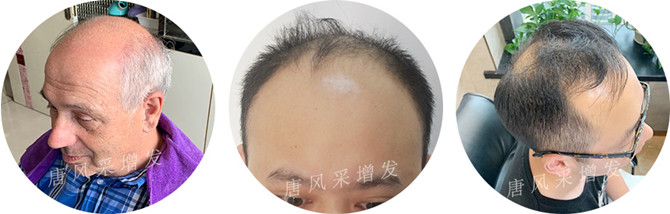 男士頭頂補(bǔ)發(fā) \