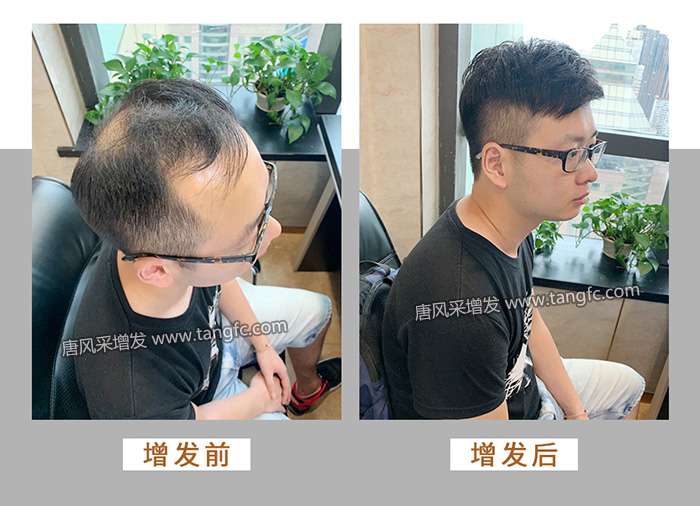 頭頂補(bǔ)發(fā)假發(fā)片 \