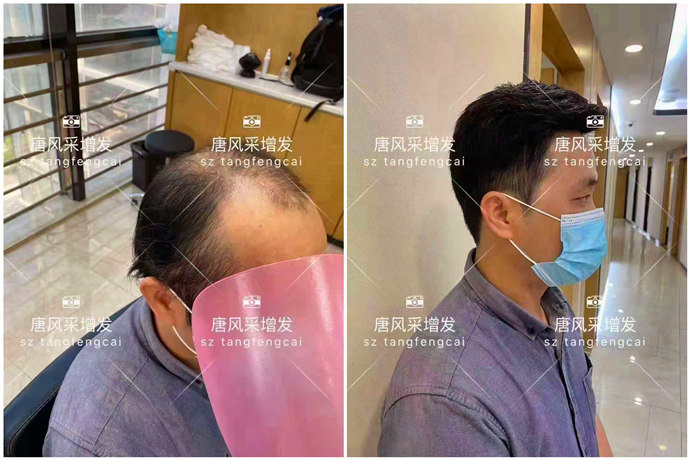 脫發(fā)男生 \