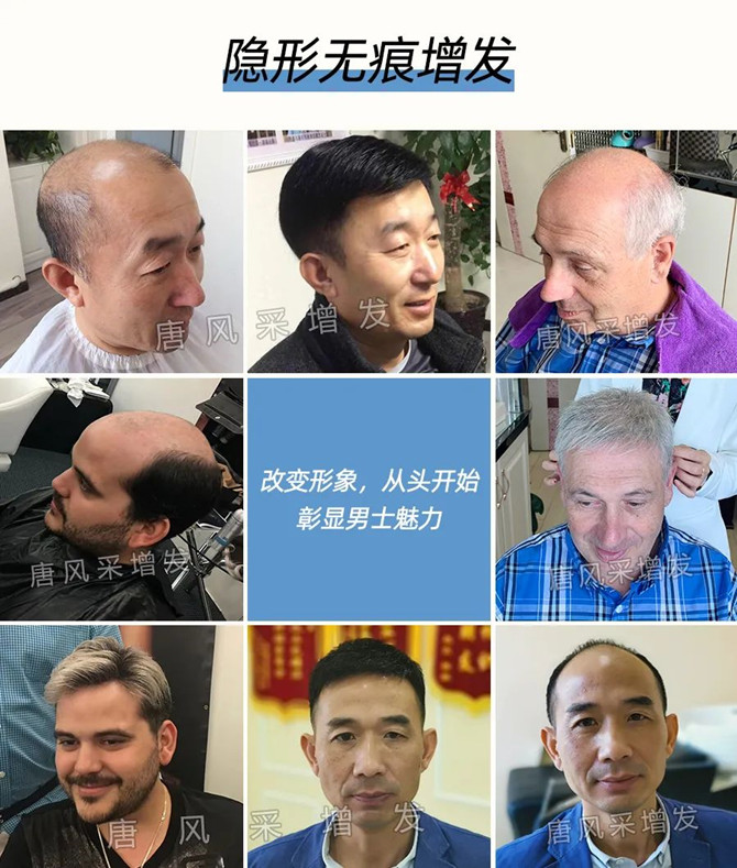 脫發(fā)男生 \