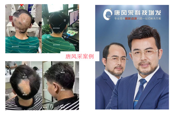 全真人發(fā)定制假發(fā) \