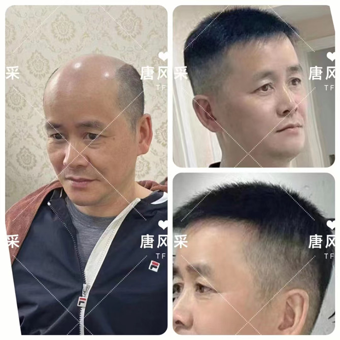 仿生長(zhǎng)無痕假發(fā) \