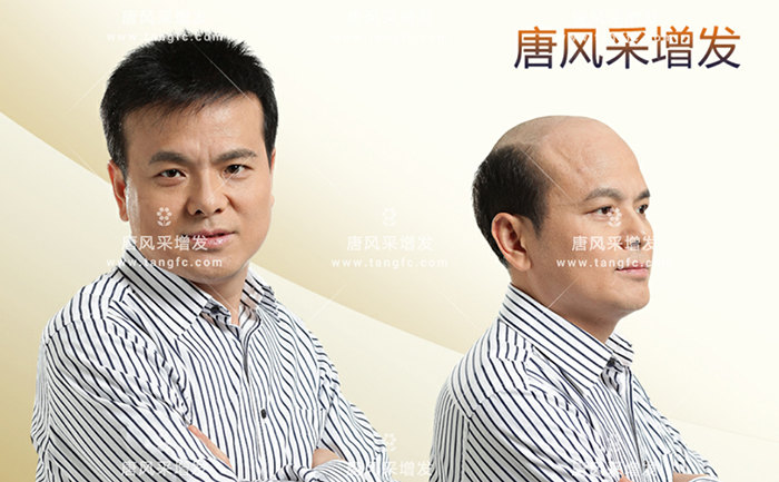 M型禿頂 \
