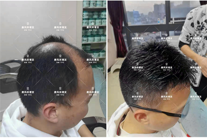 M型禿頂 \
