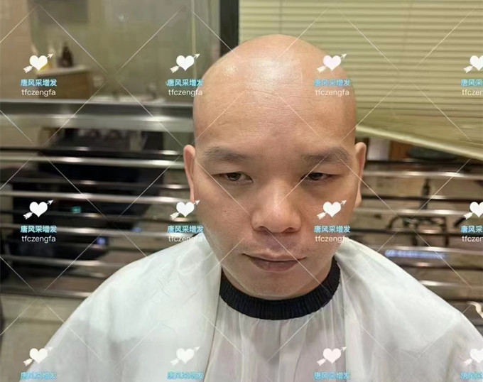 織發(fā)補發(fā) \