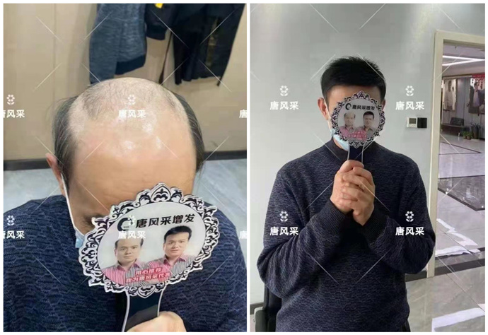 遮白發(fā)遮禿的局部假發(fā)片 \