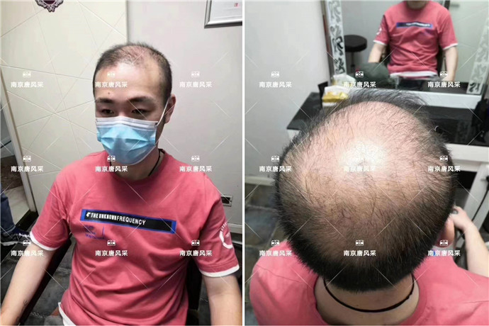 無(wú)痕增發(fā) \