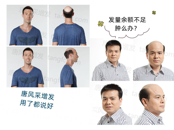 頭頂假發(fā)片 \